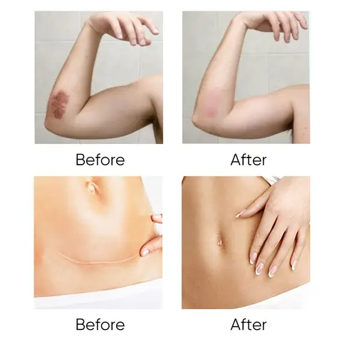 Gel de cicatrise