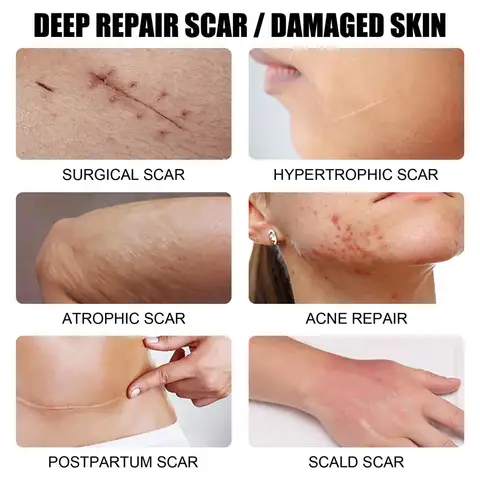 Gel de cicatrise