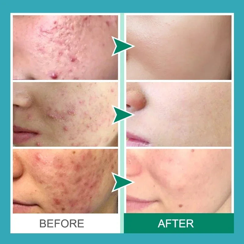 🔥Masque Facial de visage à bulles, mousse purifiante🔥