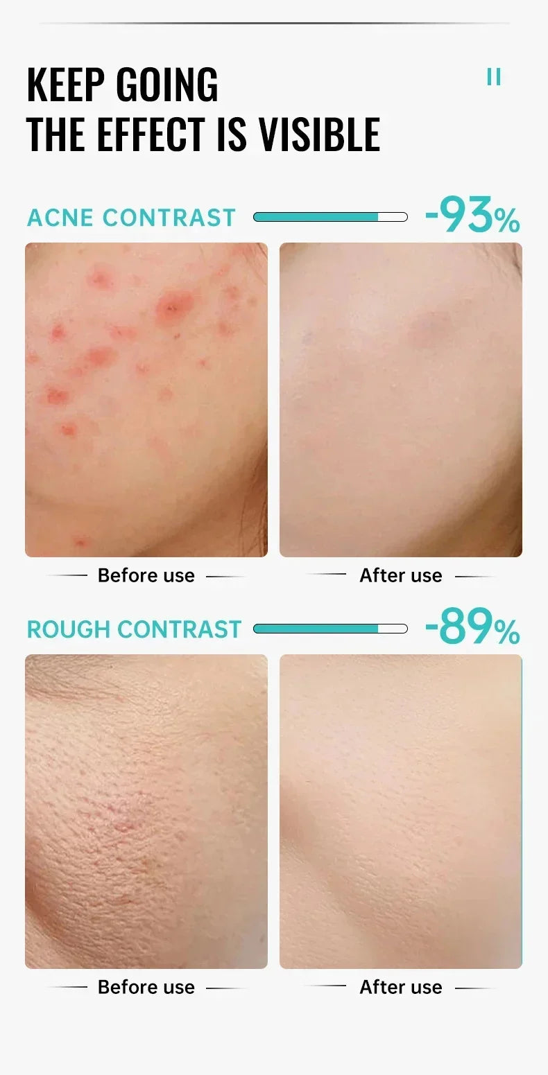 🔥Masque Facial de visage à bulles, mousse purifiante🔥